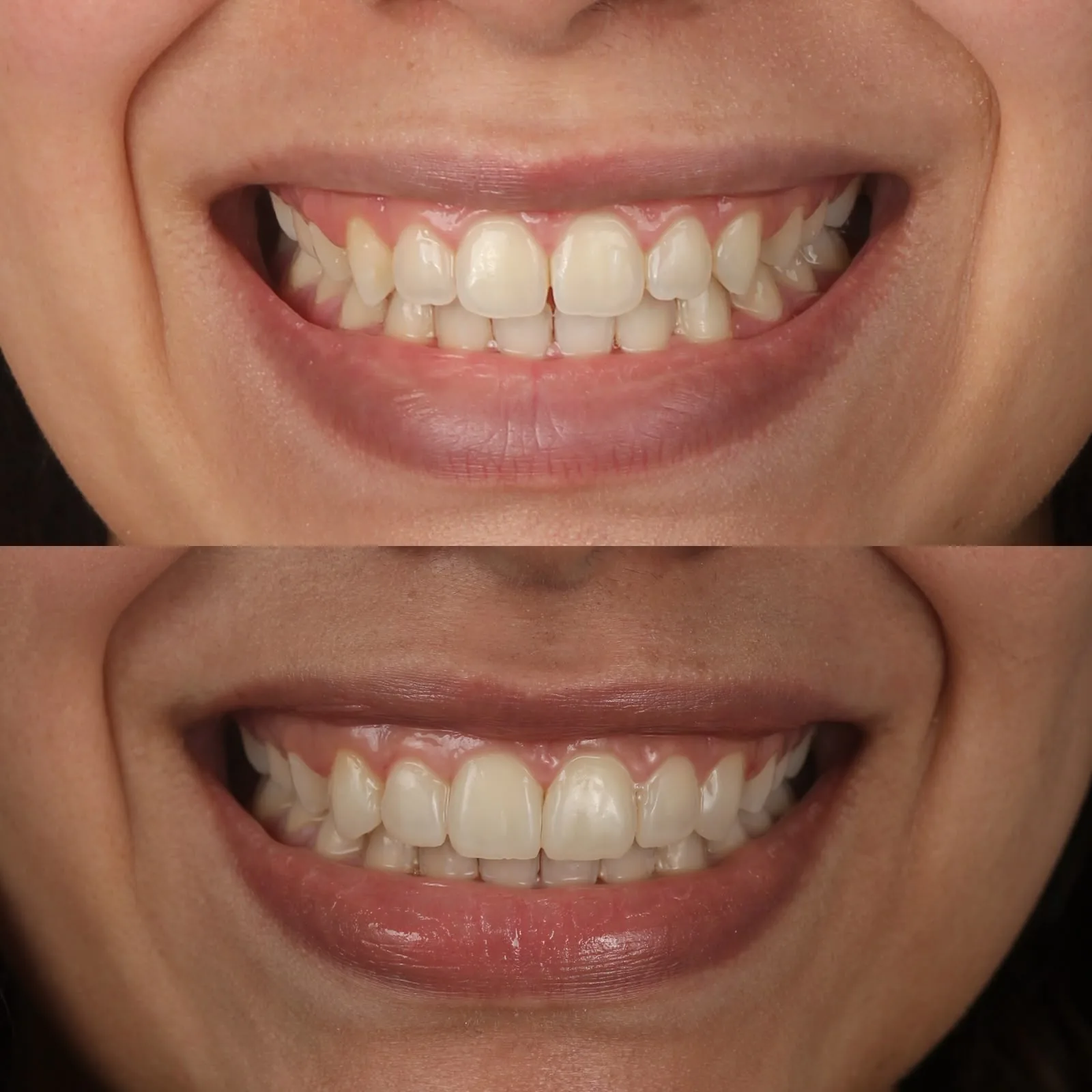Antes y después de diseño de sonrisa con resina