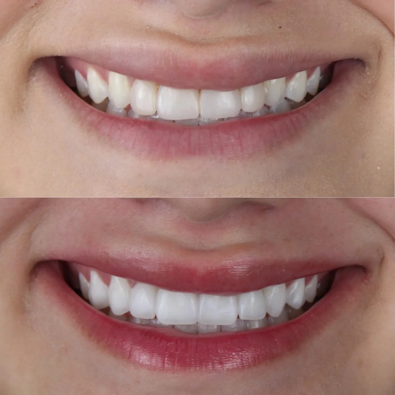 Antes y después de un diseño de sonrisa realizado por el equipo