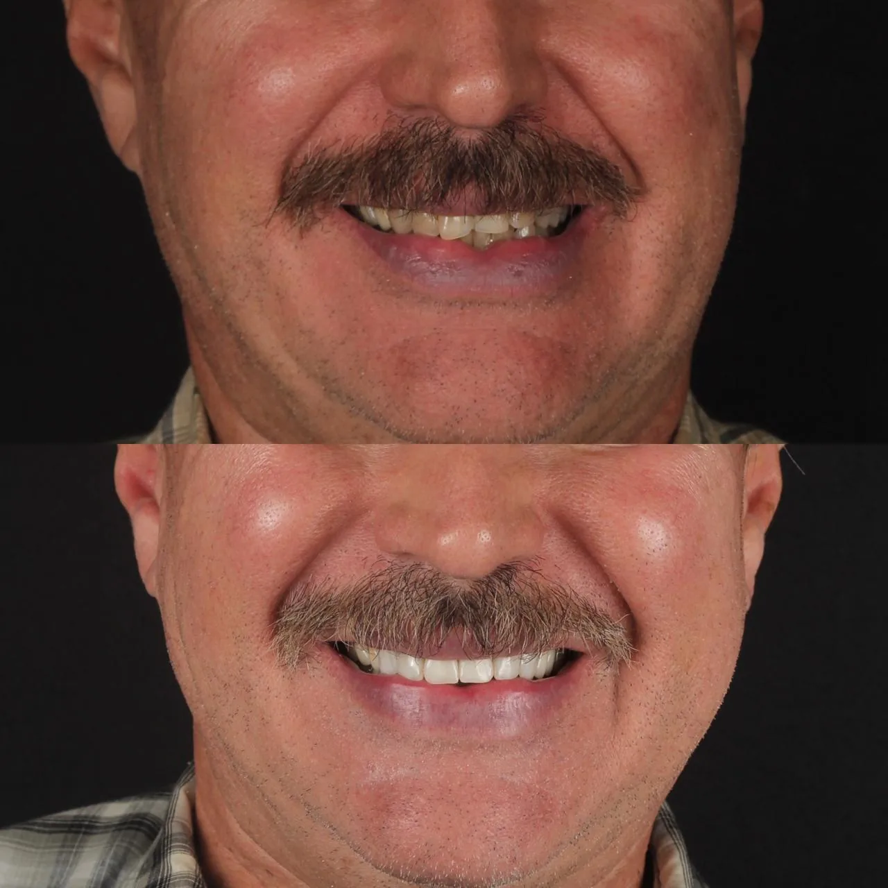 Antes y después de diseño de sonrisa