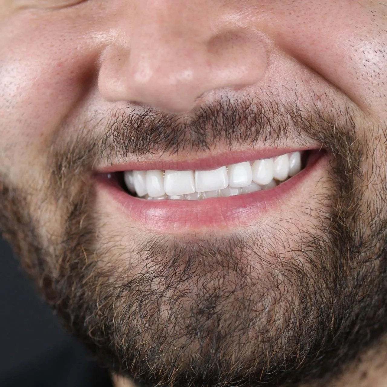 Resultado natural de diseño de sonrisa