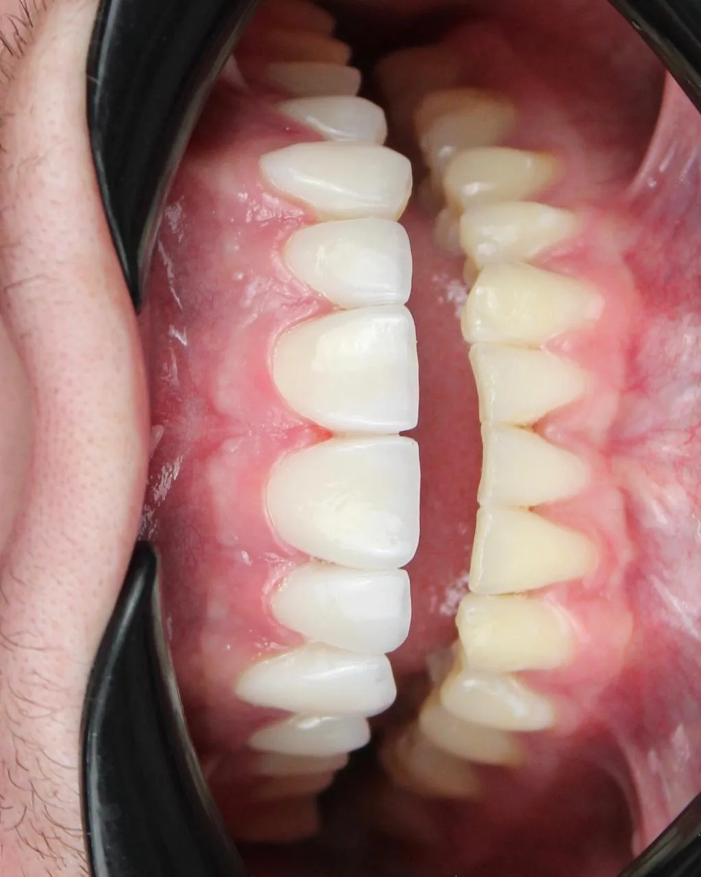 Fotografía intraoral de resultado estético