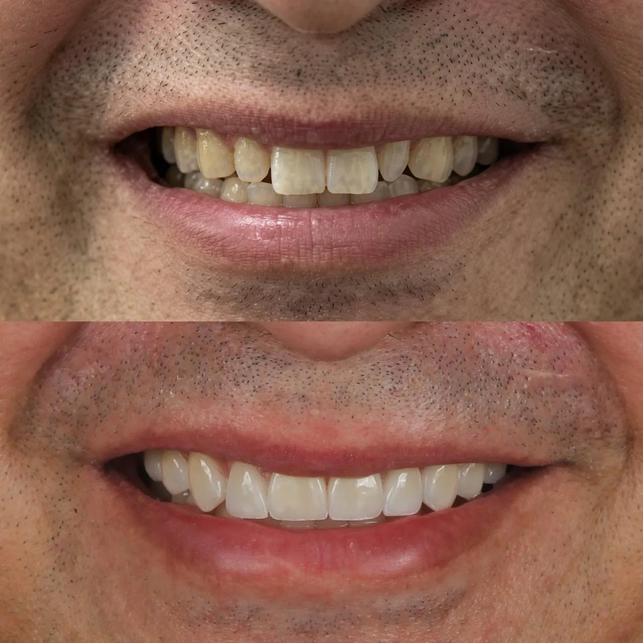 Detalle de sonrisa natural después de un tratamiento estético