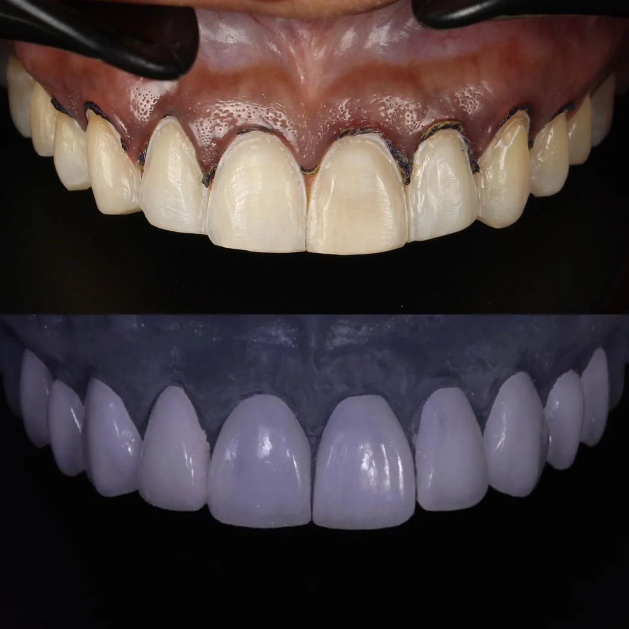 Prueba clínica y diseño de carillas de porcelana