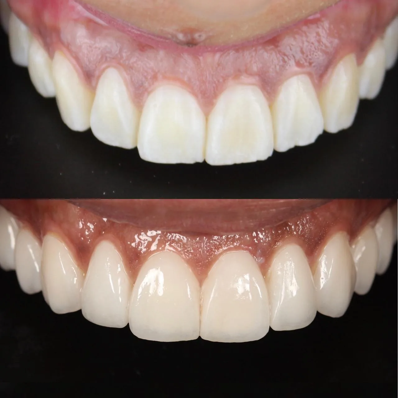 Antes y después de un tratamiento con carillas de porcelana