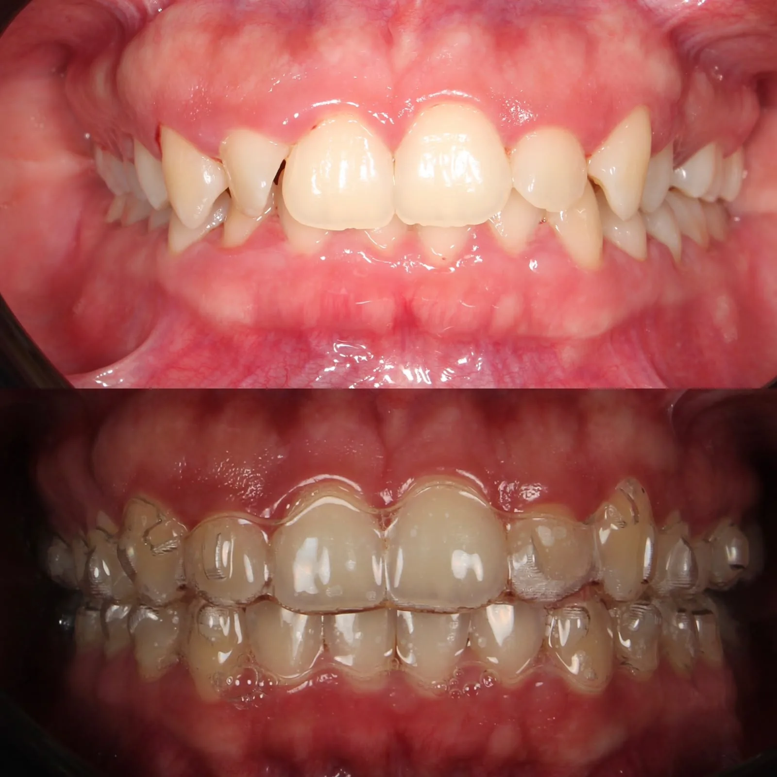 Resultado clínico de tratamiento con alineadores transparentes