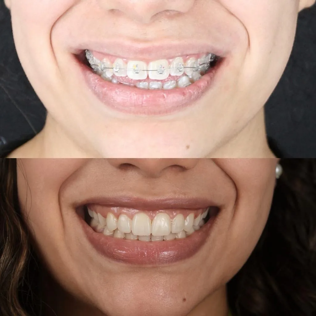 Antes y después de ortodoncia fija estética