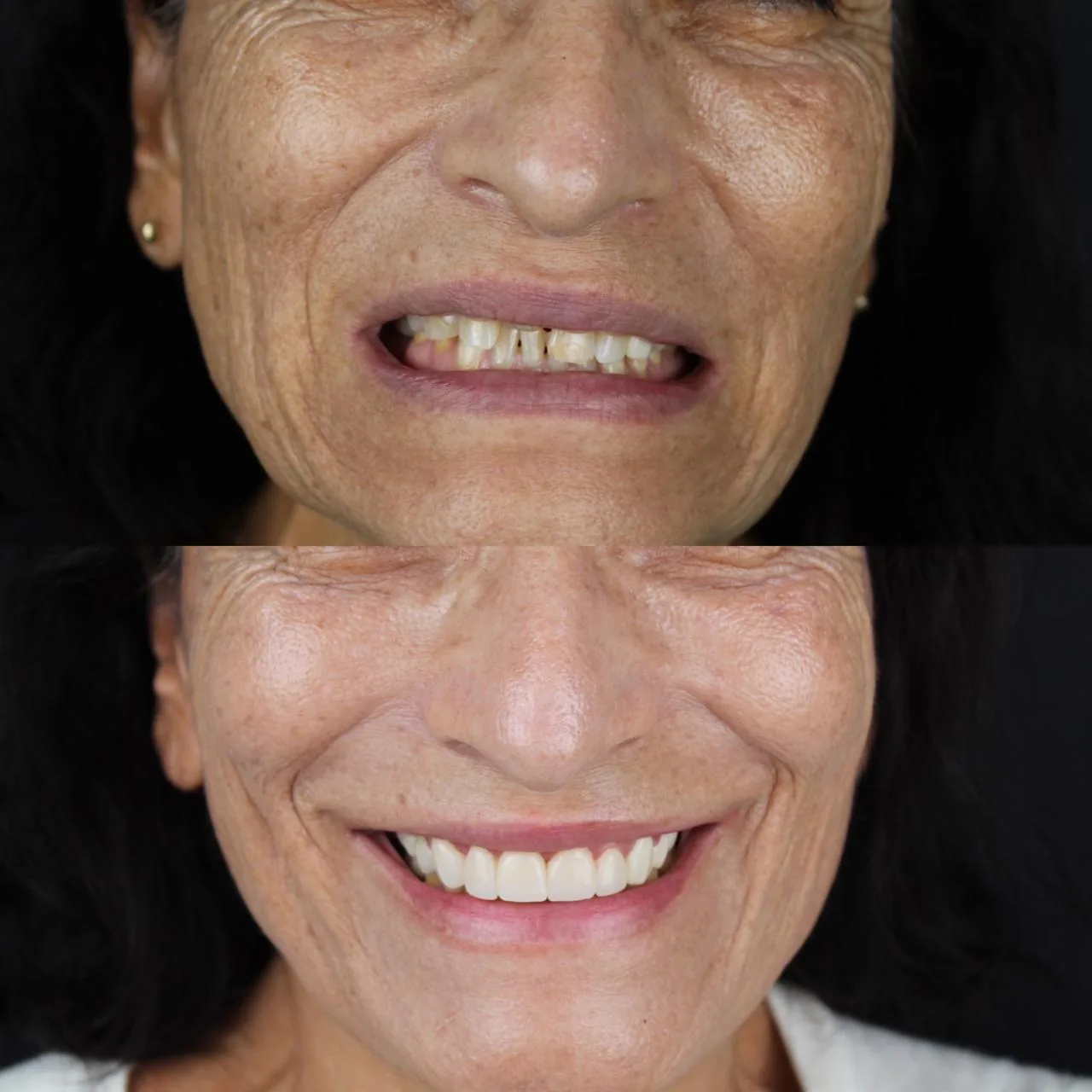 Antes y después de rehabilitación dental